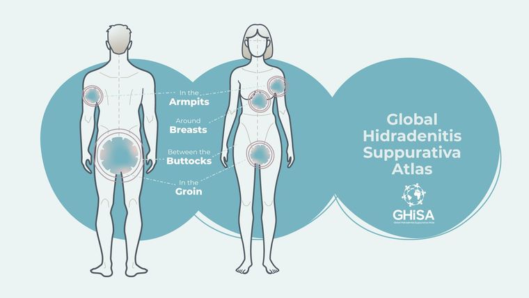 Press release | Global Report on Hidradenitis Suppurativa 2023
